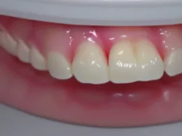 Jak samemu zrobić protezę zębową
